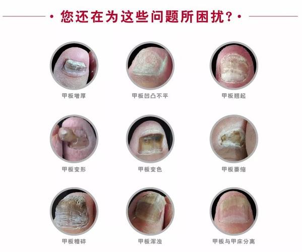 灰指甲能自愈吗（探讨灰指甲自愈的可能性和预防方法）